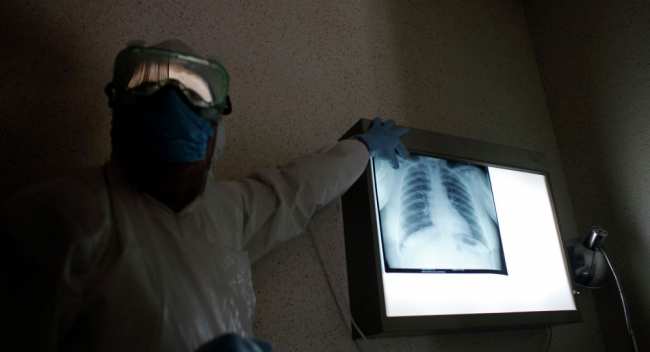 Медик показывает рентген легких пациента. Архивное фото